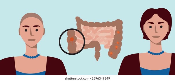 Progress before and after, patient with colon cancer, flat vector stock illustration as oncology treatment concept