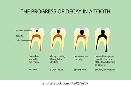 The Progress of Decay in a Tooth Diagram 