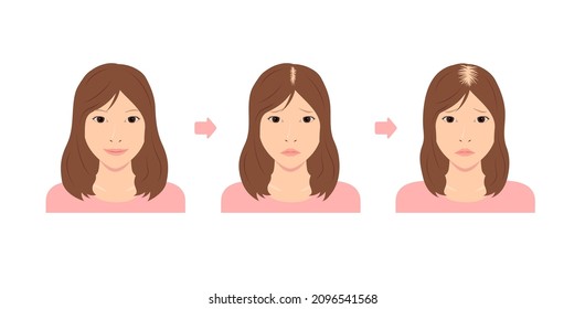 Progress of Female Androgenetic Alopecia. Vector illustration