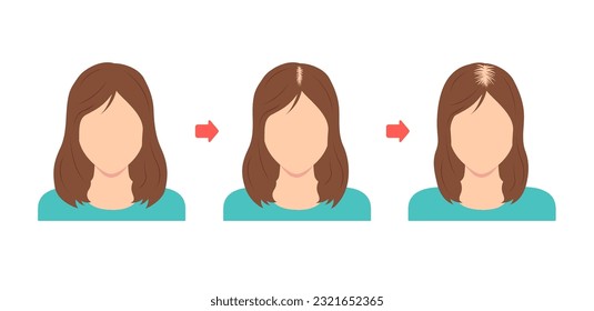 Progreso de la Alopecia Androgenética Femenina. Ilustración del vector