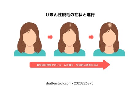 Progress of Female Androgenetic Alopecia. Vector illustration. Translation: Female Androgenetic Alopecia, The density of the entire hair decreases.