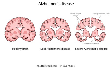 progression of Alzheimer disease, comparing a healthy brain to those with mild and severe Alzheimer structure diagram hand drawn schematic vector illustration. Medical science educational illustration