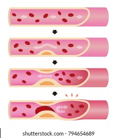 Progresión de la ilustración de la arteriosclerosis (sin texto)