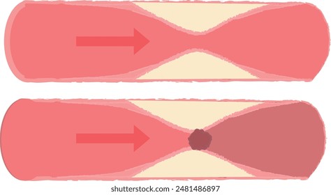 Progresión de arteriosclerosis Vasos sanguíneos normales