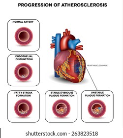 Progression Of Atherosclerosis Till Heart Attack. Heart Muscle Damage Due To Blood Clot. Very Detailed Illustration Of Fatty Streak Formation, White Blood Cells Infiltration, Blood Clot Formation Etc.