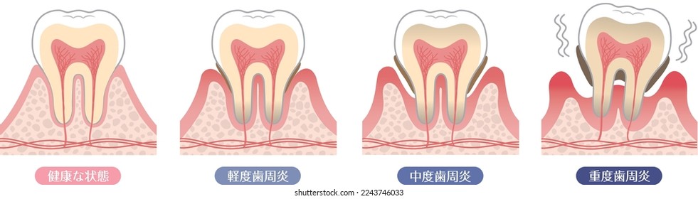 Progresión de la enfermedad periodontal

En japonés, dice "condición sana", "leve", "moderada" y "severa".