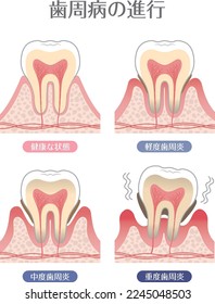 Progresión de la enfermedad periodontal

En japonés, se describen "progresión de la enfermedad periodontal", "condición sana", "leve", "moderada" y "grave".