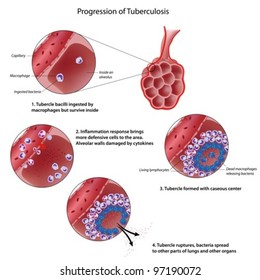 Progression of pulmonary tuberculosis