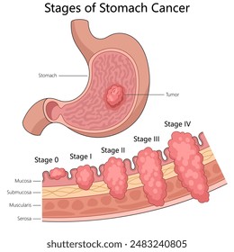 progression stages of stomach cancer from stage 0 to stage IV, highlighting tumor growth diagram hand drawn schematic vector illustration. Medical science educational illustration