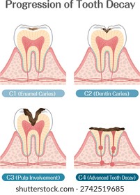 Progression of Tooth Decay C1 to C4 Dental Caries Stages Illustration