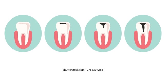 Progression of tooth decay with various stages of cavities illustrated in a sequence for educational and medical purposes.