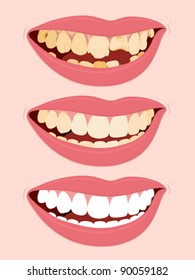 Progressive Stages Of Tooth Decay, illustration of open female mouth showing three steps to rotten teeth