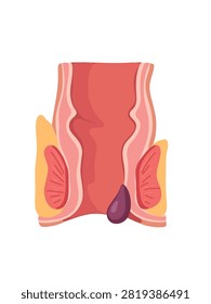 prolapsed hemorrhoid anatomy vector illustration