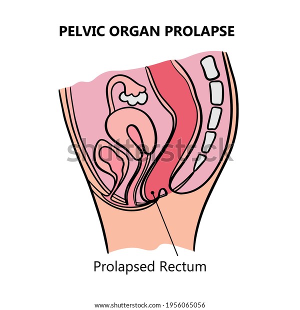 Prolapsed Rectum Women General Diagram Explanatory Stock Vector