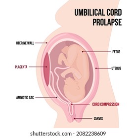 Prolapsed Umbilical Cord. Compessure Of The Cord When It Comes Out Of The Uterus By Baby. Medical Vector Diagram With Terms