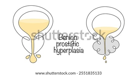 Proliferation of prostate tissue without a tendency to damage adjacent structures or metastasize. Hand drawn healthy male bladder and benign prostatic hyperplasia. Illustration on a medical theme.