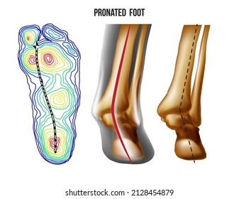 Pronated foot, arch deformation, bottom and back view . Foot weight distribution.