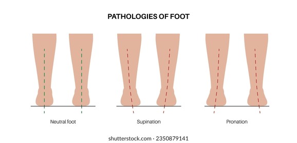 Pronation, overpronation, and supination foot position. Feet pathologies anatomical poster. Body balance problem. Ankle disease diagnostic and treatment in podiatry clinic medical vector illustration