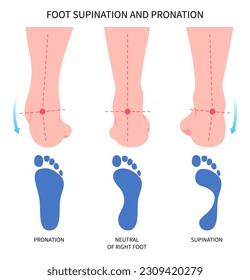 Pronation supination inward roll Feet over and Achilles Lower high fallen laxity Obesity hollow excessive of Patellofemoral tendon ligament medial tibial stress syndrome knee toe athletes sport