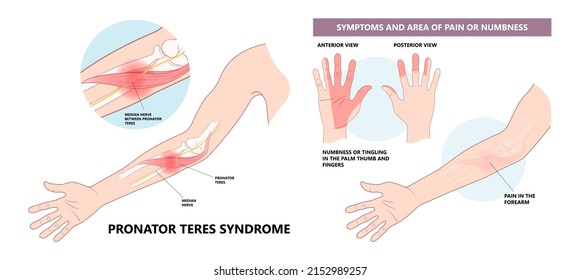 Pronator teres syndrome of nerve palsy carpal tunnel claw hand sport injury pain arm elbow joint ulnar wrist drop distal outlet neuropathies fall Radial motor tendon night Phalen test preacher papal