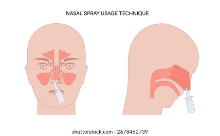 Proper nasal spray usage. Clearing the nose, holding the head upright, directing the nozzle into one nostril, and inhaling gently during spray. Correct technique ensures effective treatment vector