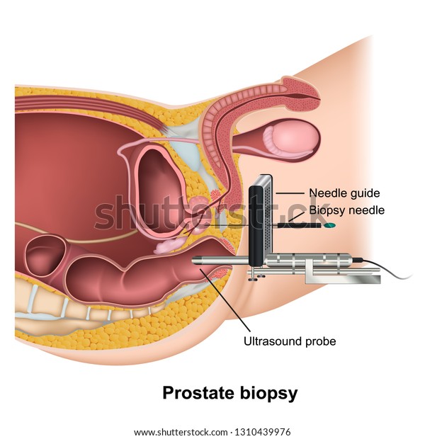 antigeno de prostata libre