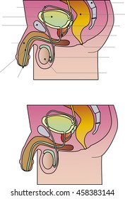 prostate cancer