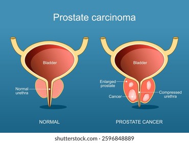Prostate cancer. Adenocarcinoma. Cross section of a human bladder and Prostate gland. Disorder of Male reproductive system. Vector illustration.