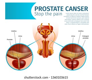 psa alton cáncer de próstata marrón psa alton cáncer de próstata marrón