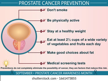 Prostate Cancer Disease Prevention Infographic Vector Illustration. Protection, Treatment, Diagnosis, And Symptoms Concept. Flat Style Medical Template. Hand-drawn Awareness Month, And Health Design. 