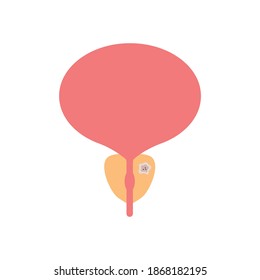 Ilustración plana de cáncer de próstata. Escalera, infertilidad, prostatitis. Concepto de tipos de cáncer. 
Se puede usar para temas como anatomía, medicina, salud
