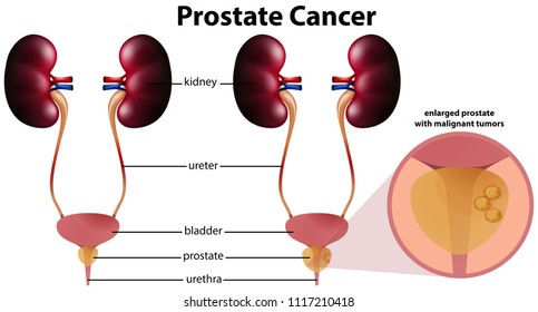 Prostate Cancer On White Background Illustration Stock Vector (Royalty ...