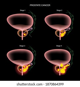 Prostate Cancer Stages Vector Poster. Pain In Bladder. Oncology, Tumor Cells In Male Reproductive System. Human Prostate Gland, Lymph Nodes Anatomy. 3d Xray Realistic Medical Infographic Illustration