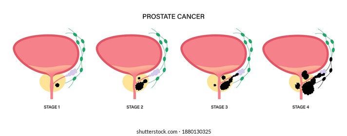 Prostate Cancer Stages Vector Poster. Pain In Human Bladder. Oncology And Tumor Cells In Male Reproductive System. Prostate Gland, Lymph Nodes Anatomy. Isolated Flat Medical Infographic Illustration