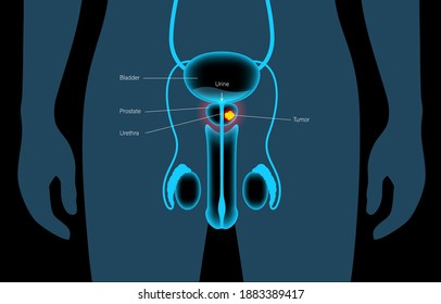Prostate cancer vector in human body. Reproductive system problem, oncology, tumor cells in male silhouette. Pain in man internal organ. Bladder, testicles anatomy. 3d xray realistic medical poster.