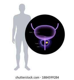 Prostate Cancer Vector In Human Body. Oncology Problem, Swelling, Tumor Cells In Male Reproductive System. Pain In Man Internal Organ. Bladder Anatomy. 3d Xray Realistic Medical Poster For Clinic.