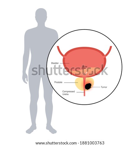 Prostate cancer vector in human body. Oncology problem, swelling, tumor cells in male reproductive system concept. Pain in man internal organ. Bladder anatomy. Isolated medical illustration for clinic