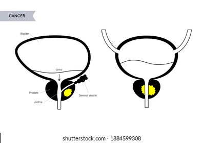 Prostate cancer vector logo for clinic. Oncology problem and tumor growth in male body. Reproductive system concept. Human internal organ, seminal vesicle, bladder anatomy flat isolated illustration.