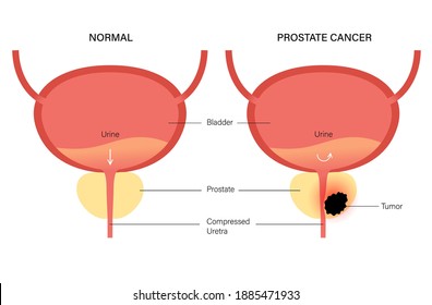 Prostate cancer vector logo for clinic. Normal bladder and oncology problem. Tumor in male reproductive system concept. Human internal organ, prostate gland, bladder anatomy flat isolated illustration