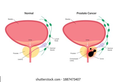Prostate cancer vector logo for clinic. Normal bladder and oncology problem. Tumor in male reproductive system concept. Human prostate gland, lymph nodes, seminal vesicle anatomy isolated illustration