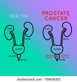 Prostate Cancer Vector Logo Icon Illustration Stock Vector (Royalty ...