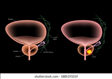 Prostate cancer vector poster. Normal bladder and tumor in male reproductive system. Oncology problem banner. Human prostate gland, lymph nodes anatomy. 3d realistic medical illustration for clinic.