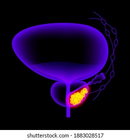 Prostate Cancer Vector Poster. Pain In Bladder, Oncology Problem. Tumor Cells In Male Reproductive System. Human Prostate Gland, Lymph Nodes Anatomy. 3d Xray Realistic Medical Illustration For Clinic.