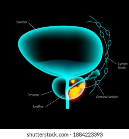 Prostate Cancer Vector Poster. Pain In Bladder, Oncology Problem. Tumor Cells In Male Reproductive System. Human Prostate Gland, Lymph Nodes Anatomy. 3d Xray Realistic Medical Infographic Illustration