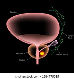 Prostate Cancer Vector Poster. Pain In Bladder, Oncology Problem. Tumor Cells In Male Reproductive System. Human Prostate Gland, Lymph Nodes Anatomy. 3d Xray Realistic Medical Infographic Illustration