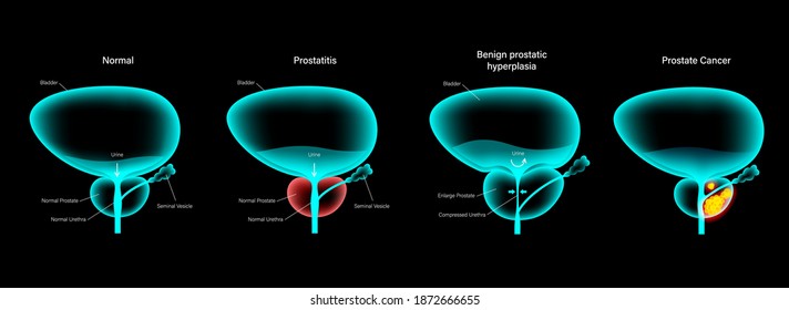 Prostate Disease Types. Normal Bladder, Prostatitis, BPH And Cancer Medical Poster. Oncology, Tumor Cells Growth In Male Reproductive System. 3d Xray Realistic Infographic Illustration For Clinic.