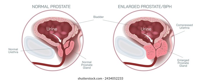 Die Prostata befindet sich bei Männern direkt unter der Blase und umgibt den oberen Teil des Tubus, der den Urin aus der Blase oder dem Harnröhrenvektor ableitet. Studenten studieren Material.