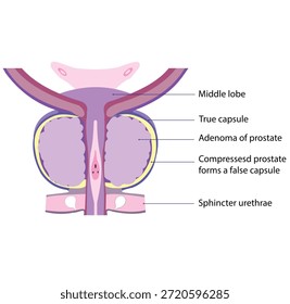 Un adenoma prostático causa un agrandamiento benigno de la próstata, comprimiendo el tejido normal hacia afuera y formando una cápsula falsa circundante.