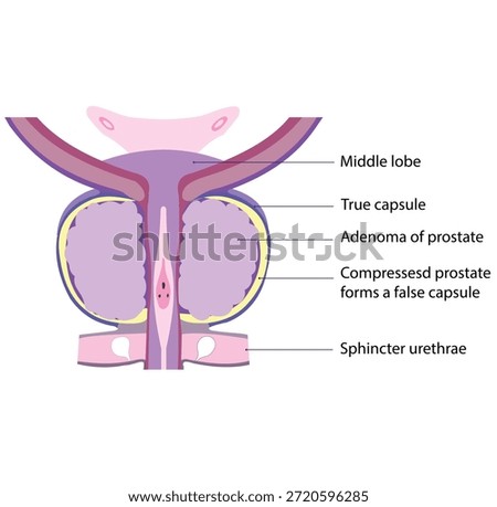 A prostatic adenoma causes benign enlargement of the prostate, compressing normal tissue outward and forming a surrounding false capsule.