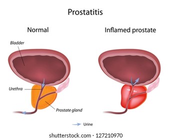 Prostatitis Harbingers)